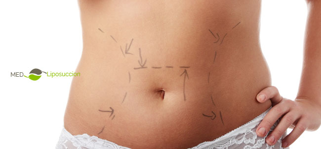 liposuccion en tunisie